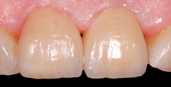 impianto dente singolo estetica dopo