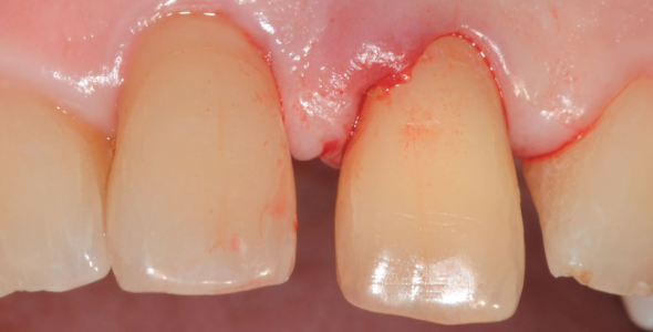 impianto dente singolo estetica prima